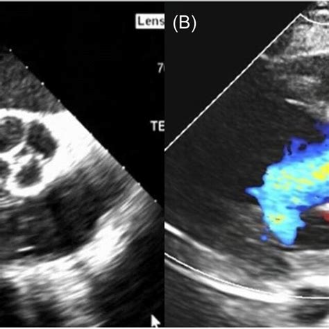 Transesophageal Echocardiogram A Short‐axis View Of The Quadricuspid
