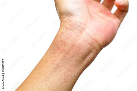 Red Rash On Wrist Isolated On White Background Rashes On Skin Caused