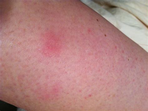 Reddish Bumps On Skin Pictures Photos