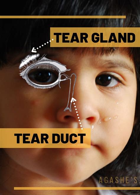 Does Your Child Have A Blocked Tear Duct Agashe Hospital