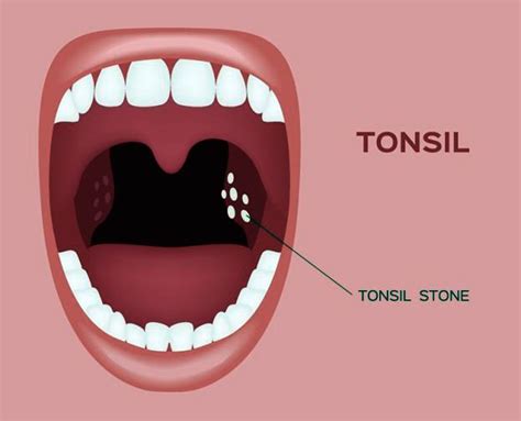 Tonsil Stone Tonsillectomy Tuesday Q And A Self Care Steps May Help