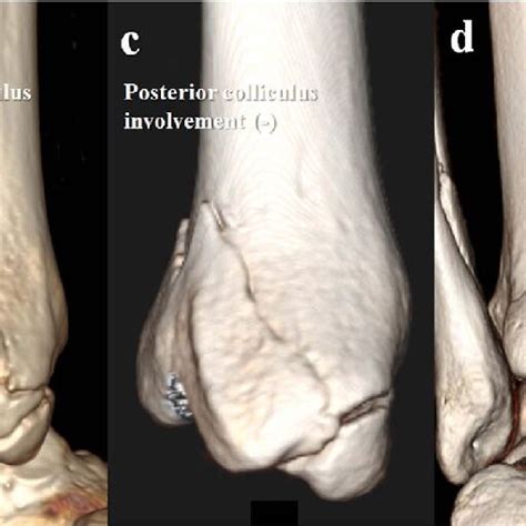 Our Classification System For Posterior Malleolar Fractures We Divided Download Scientific