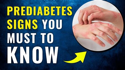 8 Prediabetes Signs You Must Know Before Its Too Late Diabetesaz