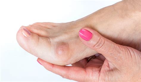 Bunions Causes Symptoms Treatment Wisconsin Foot Center