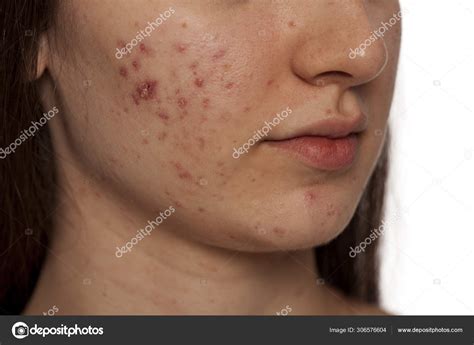 Closeup Teenage Girl Problematic Skin White Background Stock Photo By