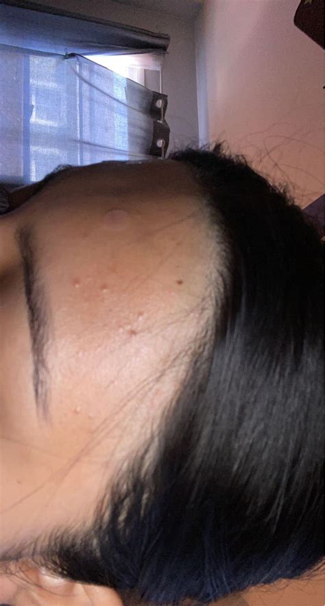 Small Bumps On Forehead Anyone Know What They Are And How To Get Rid