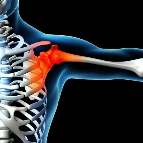 Shoulder Pain Novus Spine And Pain Center Lakeland Florida