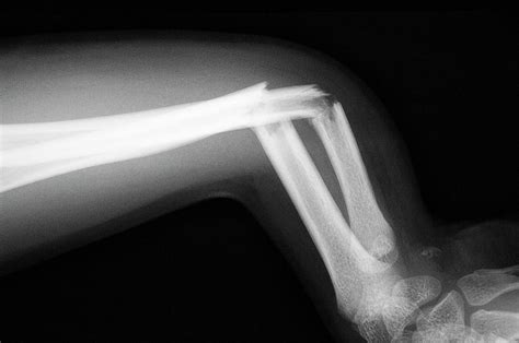 Broken Arm Photograph By Dr P Marazziscience Photo Library