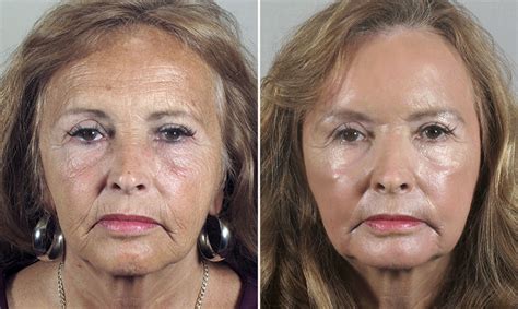 Chemical Peels In New Jersey The Parker Center For Plastic Surgery