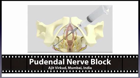 Nerve Block Youtube Pudendal Nerve Block
