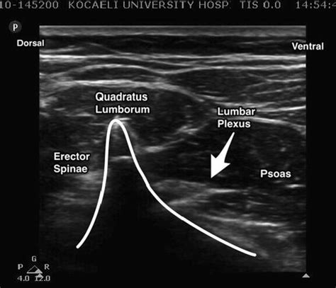 Ultrasound Image Of Lumbar Plexus With Shamrock Method Download
