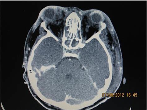Figure 4 From Bilateral Traumatic Globe Luxation With Optic Nerve