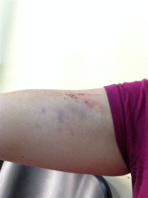 Right Upper Arm Bruises Photo