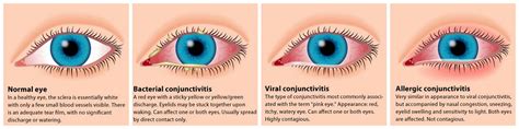 What Is Pink Eye And How Do I Treat It Directmed Dpc Affordable