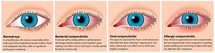 What Is Pink Eye & How Do I Treat It? - DirectMed DPC – Affordable ...
