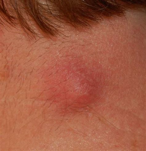 Lump On Neck Causes And Pictures