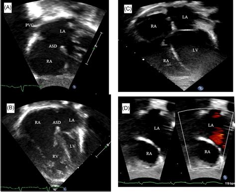 Subcostal And Apical Four Chamber Transthoracic Echocardiogram Of