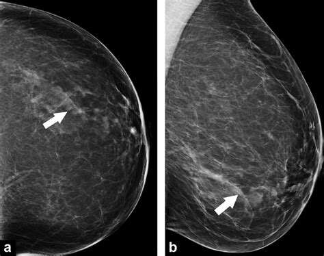 A 58 Year Old Woman Undergoing Screening Mammogram Without Personal