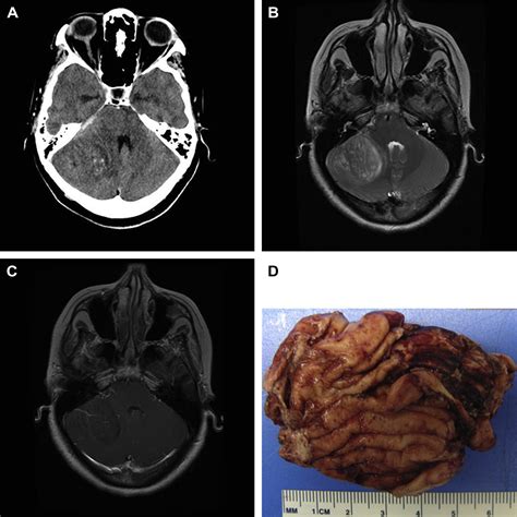 Posterior Fossa Tumors In Adult Patients Neuroimaging Clinics