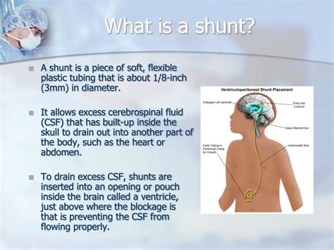Ppt Hydrocephalus And Shunts Powerpoint Presentation Id431868