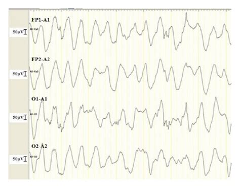 Encephalographic Eeg Findings Before And After Ictal Events On Day 1