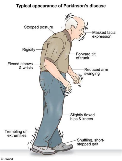 Parkinsons Disease Causes A Shuffling Gait And A Mask Like Facial