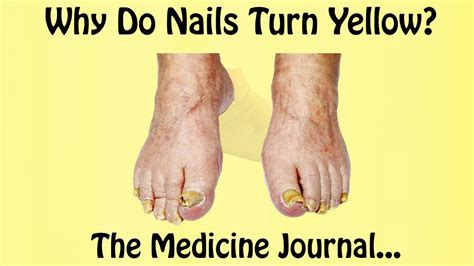 We did not find results for: WHY DO NAILS TURN YELLOW? - YouTube