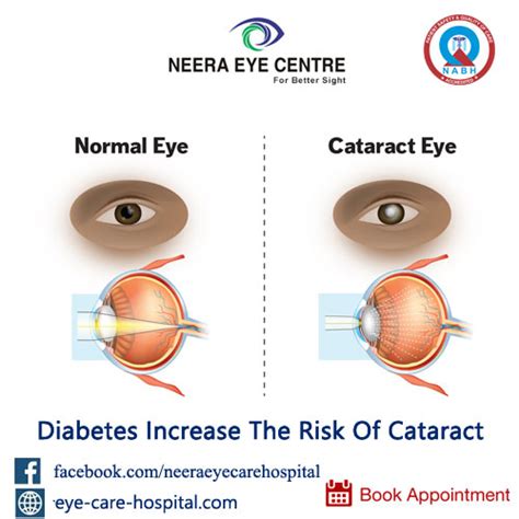 Eye Care Treatments Delhi Cataract Treatment India