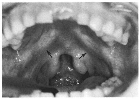 Figure 1 From Submucous Cleft Palate Review And Two Clinical Reports