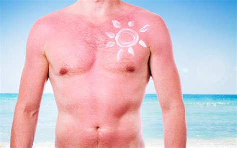 how to treat sunburn naturally at home