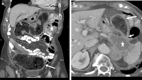 A 82 Year Old Female With Abdominal Pain And Constipation Coronal A