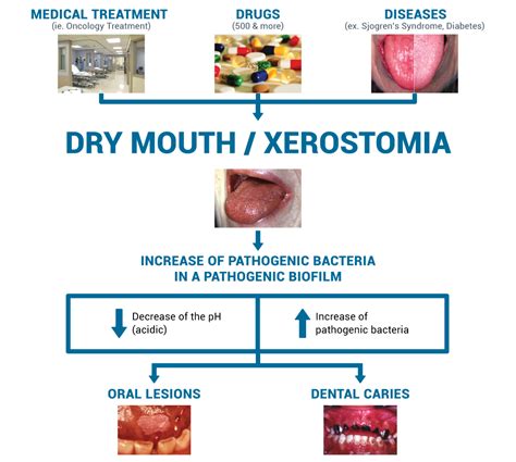 Xerostomia How To Relieve Dry Mouth Symptoms Oral Science Boutique