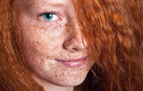 Freckles The Skin Care Clinic