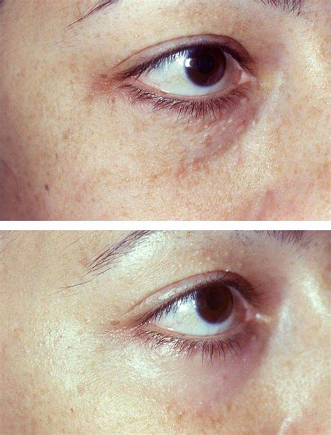 Syringoma Removal Sydney Nsw Áda Aesthetic Medicine