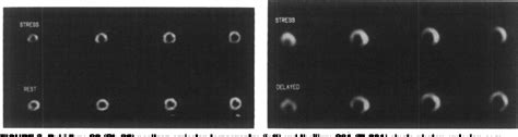 Figure 1 From Comparison Of Rubidium 82 Positron Emission Tomography