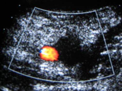 Ultrasound Imaging In Vascular Diseases Intechopen