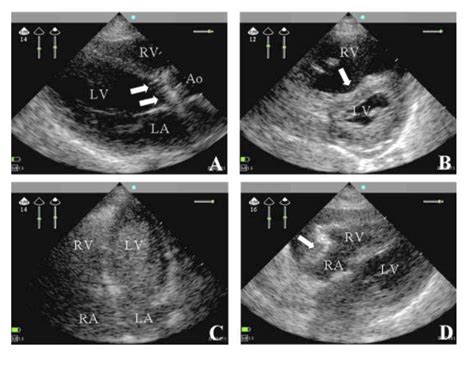 Cureus Cardiac Ultrasound In The Intensive Care Unit A Review