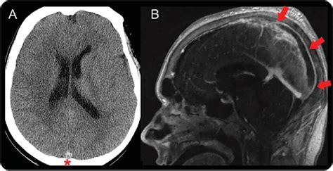 Enous Thrombosis Of The Superior Sagittal Sinus Download Scientific