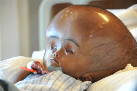 Roona Begum Three Year Old Makes Amazing Recovery After Swollen Head