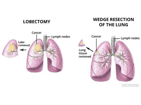 Lung Sparing Surgery Effective For Early Stage Lung Cancer Nci