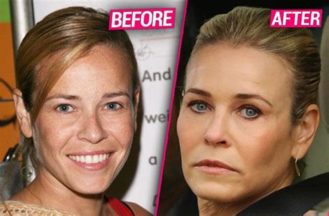 Had A Facelift Lately Chelsea Handler S Frozen Face Exposed Before After Photos