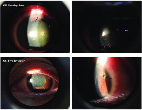 Top Slit Lamp Photographs Of The Right Eyes On The Fifth Day Of The
