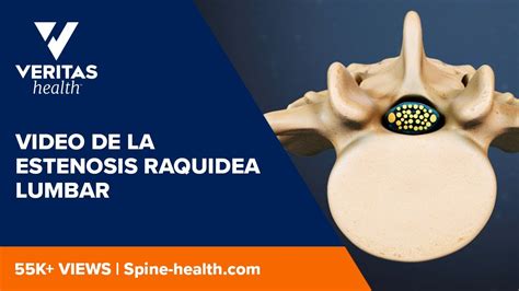 Video De La Estenosis Raquidea Lumbar Youtube