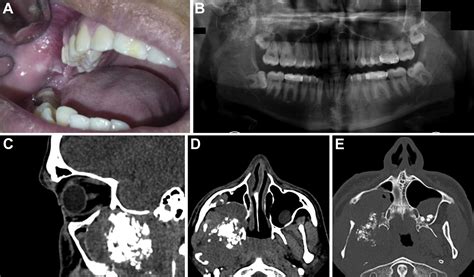 A Mixed Image In The Maxillary Sinus Oral Surgery Oral Medicine