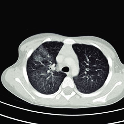 Initial Chest Ct Demonstrated The Extent Of The Airspace Filling