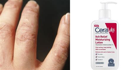 What is the outlook for discoid eczema? eczema: eczema cream for adults