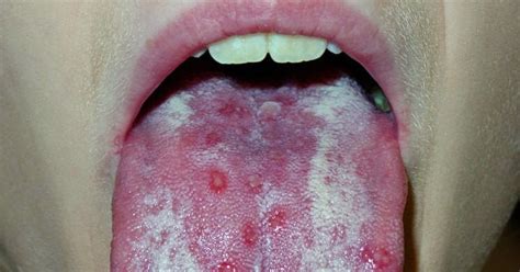 The herpes virus was transmitted to you by skin to skin contact by a person who already had the virus. The Herpes Simplex Roof Of Mouth