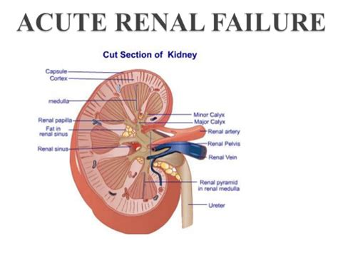 Acute Renal Failure Causes And Symptoms