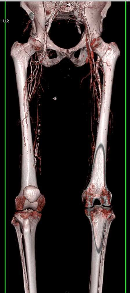 Cta Runoff With Right Superficial Femoral Artery Sfa Occlusion And