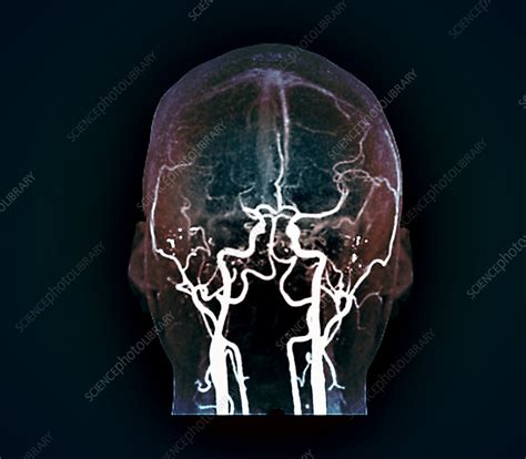 Thrombosis Mri Angiogram Scan Stock Image C0530092 Science